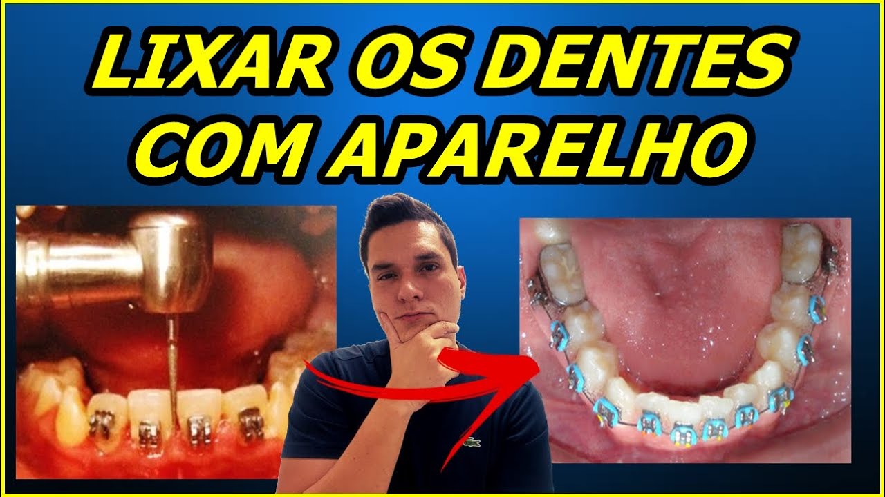 É POSSÍVEL LIXAR OS DENTES PARA ALINHAR COM APARELHO FIXO | SLICES EM ORTODONTIA.
