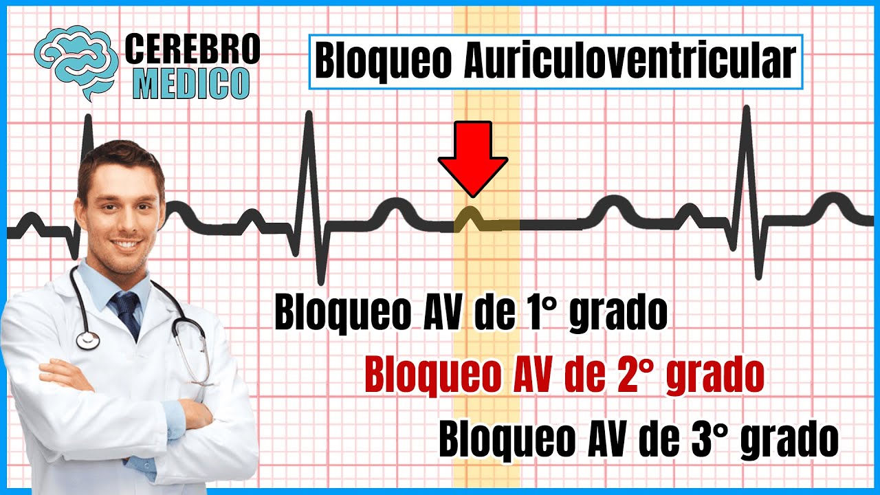 Bloqueos Auriculo-ventricualres (BLOQUEOS AV de 1°, 2° y 3°) | ▷ Como leer un EKG paso a paso