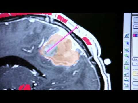 Brainlab Software Helps Deliver Better Chemotherapy Therapy to Patients