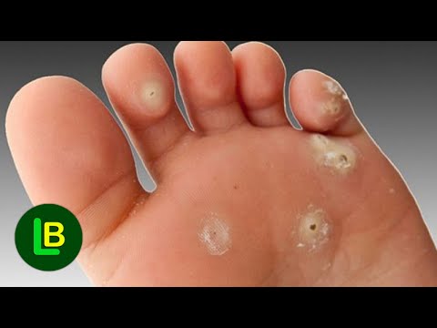 Natural remedy for corns