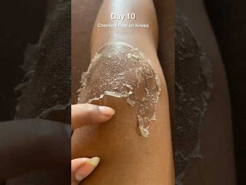 Chemical peel on knees Day 10 #chemicalpeel #chemicalpeeling #chemicalpeeljourney #tcapeel #peels