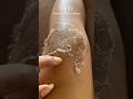 Chemical Peel On Knees Day 10 Chemicalpeel Chemicalpeeling Chemicalpeeljourney Tcapeel Peels