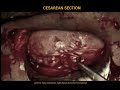 OPERASI CAESAR C Section Delivery