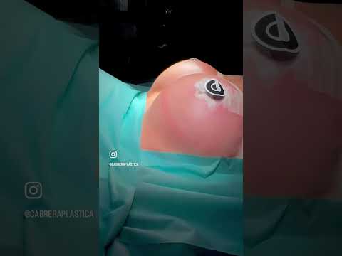 Otro de nuestros casos: Reducción mamaria