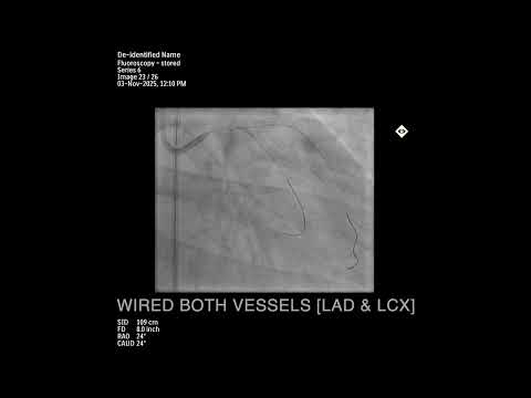 Left Main Coronary Bifurcation Stenting | DK Crush Technique Explained