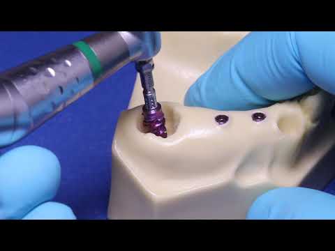 Straumann® BLX Implant System - Extracted Molar