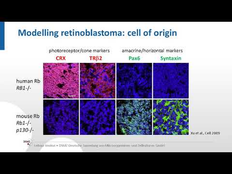 A human stem cell based model for retinoblastoma