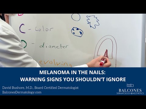 Melanoma in the Nails: Warning Signs You Shouldn’t Ignore