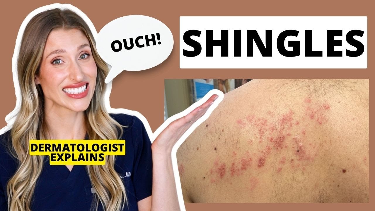 Dermatologist Explains Shingles: Is it Contagious? Shingles Treatments & Prevention? | Dr. Sam Ellis