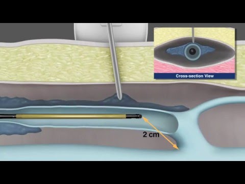 Radiofrequency Fibre In Action - RFA Vein Treatment