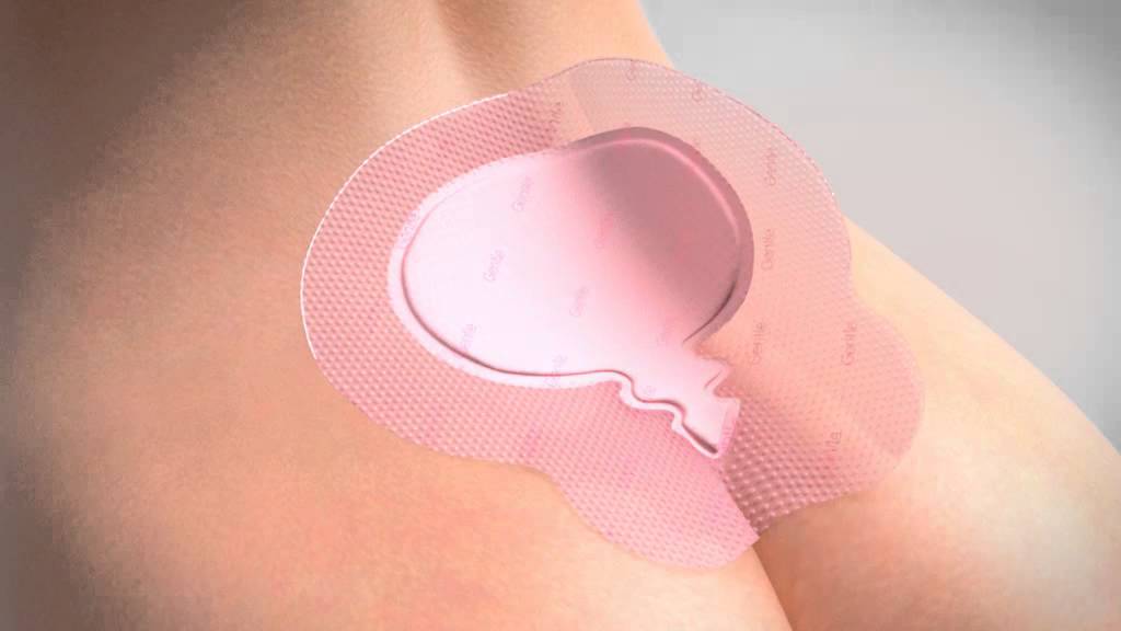 Application of ALLEVYN Gentle Border Sacrum Dressing to the Sacral area