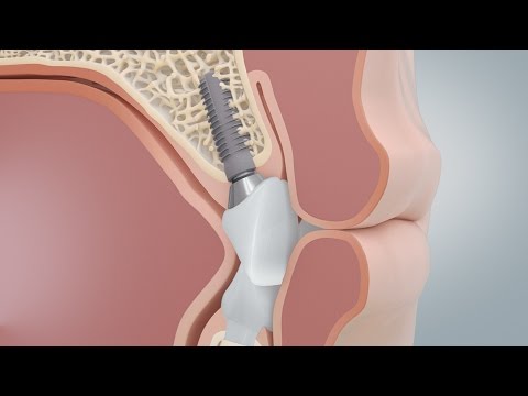 Vergleich von Zahnimplantat und Zahnbrücke (3D-Animation)