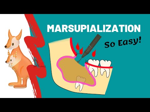 Marsupialization | WHEN, WHY & HOW?