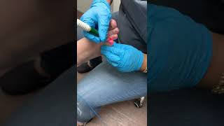 GOT FUNGUS LASER PROCEDURE FOR TOENAIL FUNGUS 💥🍄💥🍄💥