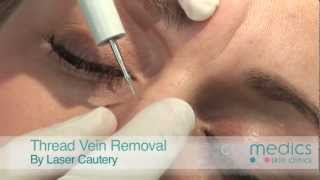 Thread Vein Removal on Face by Laser - London
