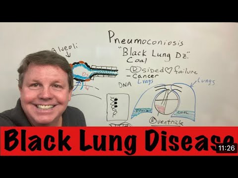Pneumoconiosis Black Lung Disease