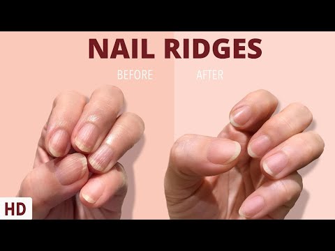 Nail Ridges: The Silent Signaling Your Nails Are Trying to Tell You