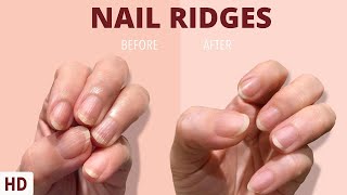 Nail Ridges: The Silent Signaling Your Nails Are Trying to Tell You