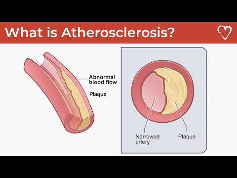 What is Atherosclerosis?