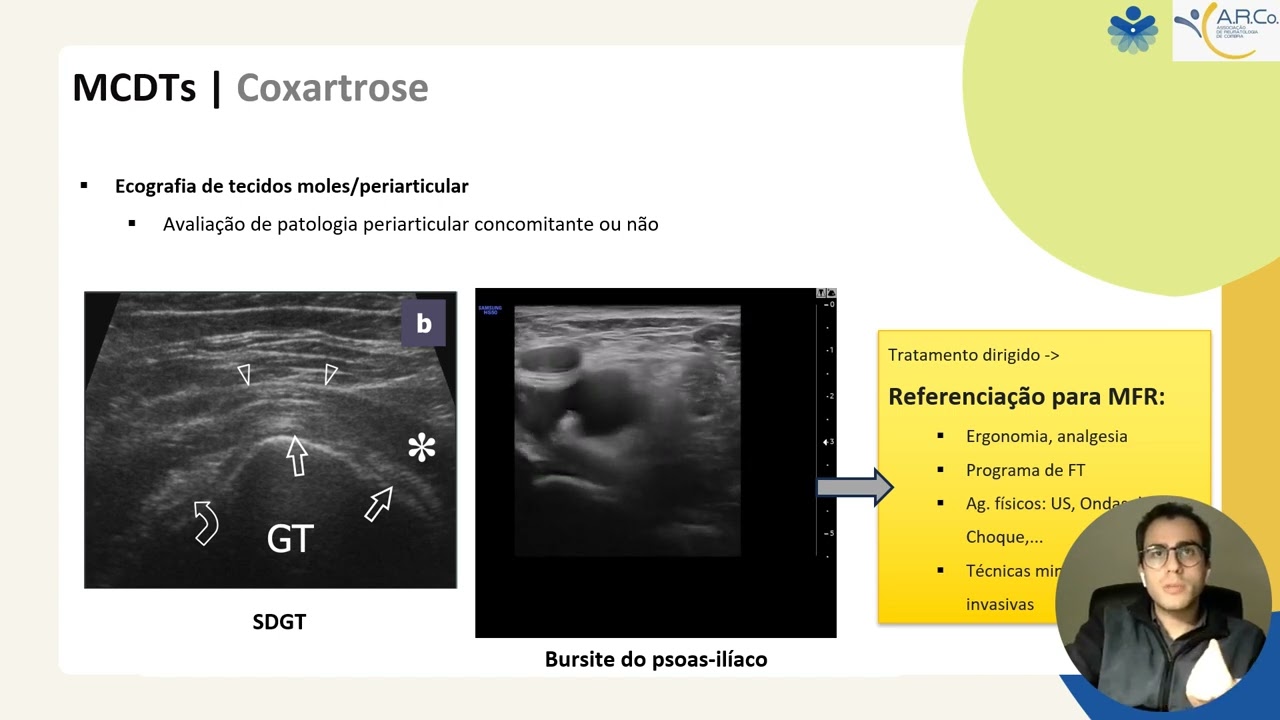 Medicina física e reabilitação para não especialistas - Coxartrose