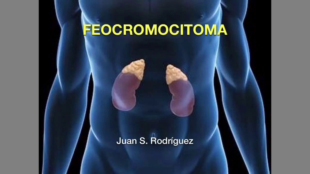 Suprarrenales: Feocromocitoma