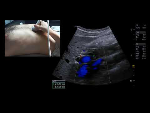 Sonographie der Leberpforte und Gallenblase