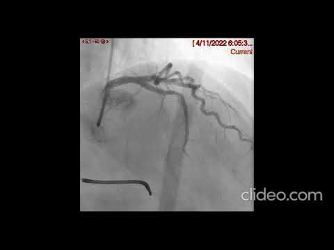 Video 2: Slow flow in distal LAD.