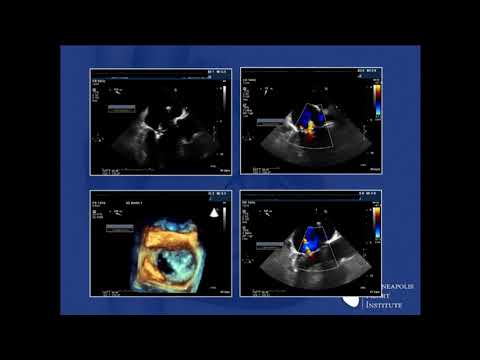 Novel Ways to Treat Residual Regurgitation - Paul Sorajja, MD