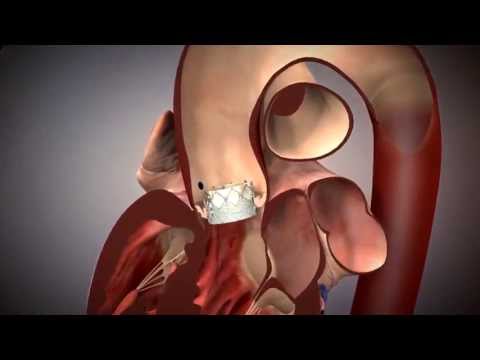 TAVR - Transcatheter Aortic Valve Replacement Animation