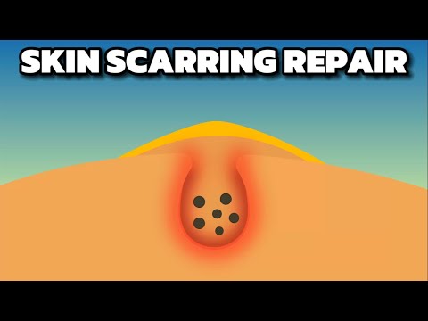 Skin Scarring Repair Morphic Field - For All Types Of Scars, Allergies, Burns and Infections