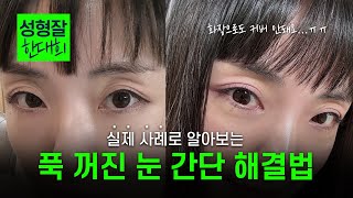 EDITION TV - 나이 들어 보이는 꺼진눈, 겹주름 고민이신가요? | 간단 해결법