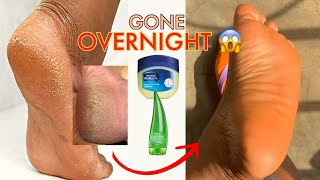 How to get rid of dead skin from your feet at home OVERNIGHT | no dry and cracked heels
