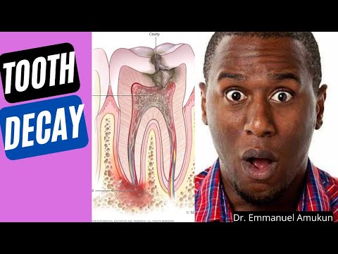 , title : 'The Process of tooth Decay | How tooth cavities develop| How to identify and stop tooth decay!'