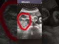 baby girl ultrasound beautiful baby girl boy or girl usg