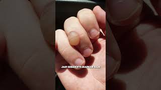 Download lagu Should We Pop the Calluses Bubble or Should We Not? 🤔🤔 mp3