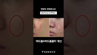모피어스8 성형 시술