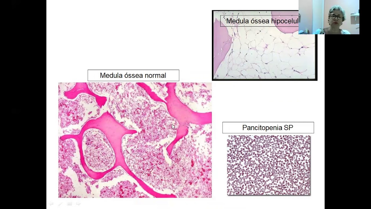 Video anemia aplasica e hemorrágica