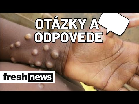 Opičie kiahne: Časté otázky a odpovede