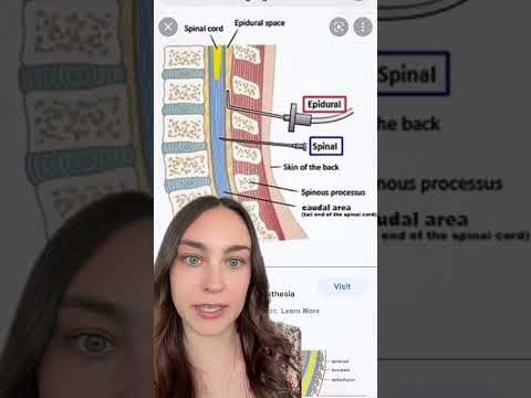 How do you get a spinal put in? #greenscreen #spinal #spinalanesthesia #labourandbirth