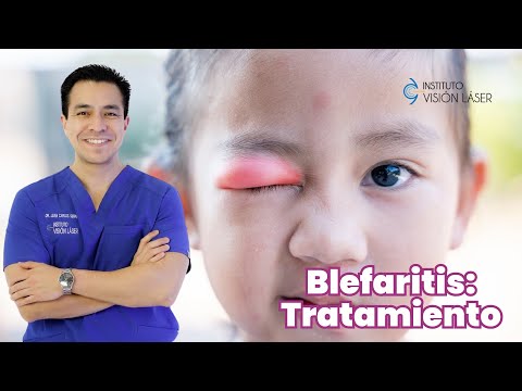 Blefaritis : Tratamiento