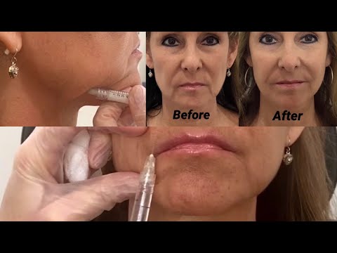 How to Get Rid of Jowls with Dermal Fillers!