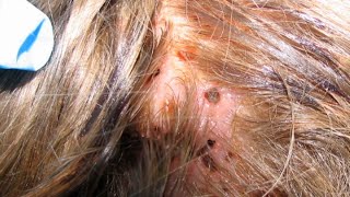 Mysterious Lesions on Girl&#39;s Head Turn Out to be Flesh-Feasting Parasite