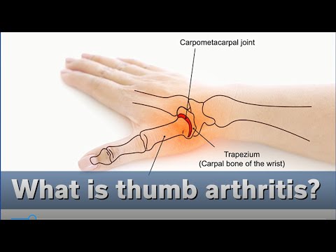 CMC/Thumb Arthritis : Learn More from a Hand Therapist