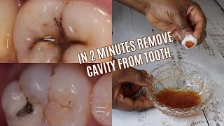 HOW I REMOVED CAVITY FROM TOOTH AT HOME WITHOUT  GOING TO THE DENTIST
