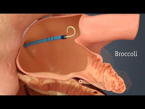 Watchman Device for LAA Closure