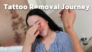 Tattoo Removal Journey | What I Wish I Knew Before Getting Tattoos