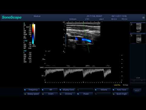 ЦДК и спектр скоростей кровотока позвоночной артерии. Апробация УЗИ аппарата SonoScape S2N