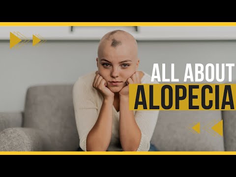 🔴Doctor explains Alopecia Areata (aka patchy or total hair loss) - Signs, Symptoms, Treatment & more