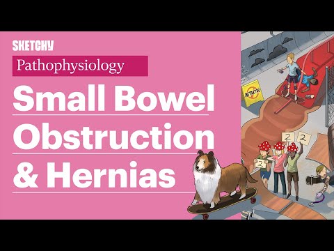 Small Bowel Obstruction (SBO), Ileus, & Hernia (Part 1) | Sketchy Medical  | USMLE Step 1.
