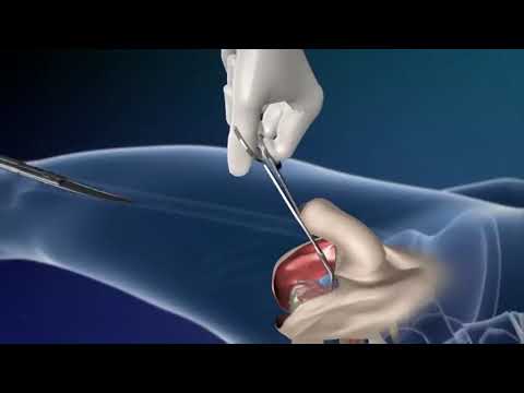 Transgender Male to Female Surgery  Reassignment #transgender #transwoman #திருநங்கை